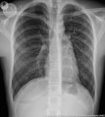 Ct scan did not reveal any blebs and his diagnosis was spontaneous pneumothorax. Spontaneous Pneumothorax International Emergency Medicine Education Project