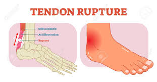 Learn more about foot tendon problems and common tendon problems of the foot from the medical experts at foot vitals. Tendon Rupture Anatomical Example Vector Illustration Diagram Educational Medical Scheme With Soleus Muscle And Achilles Tendom Royalty Free Cliparts Vectors And Stock Illustration Image 95813290