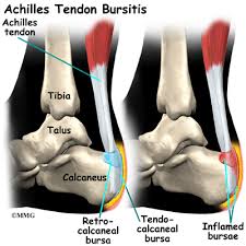 The achilles (calcaneal) tendon is a common tendon shared between the gastrocnemius and soleus muscles of the posterior leg. Patient Education Concord Orthopaedics