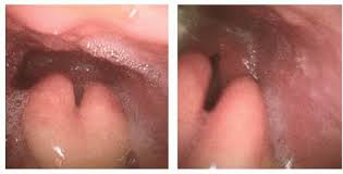 Image result for Epiglottitis