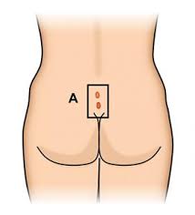 Learn what causes lower back pain during pregnancy and what you can do to ease or prevent backache during pregnancy. Pilonidal Disease Ascrs