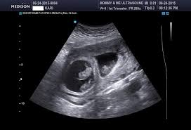 Pin En Ultrasound Surrobaby Pics