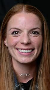 Transforming Taylor Paul's Smile: The Power of Small Changes