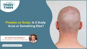 Image result for white scabs on the head in children