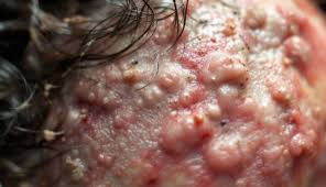 Image result for folliculitis symptoms