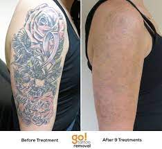 Pin On Tattoo Removal In Progress