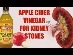Very Easy Ways To Use Apple Cider Vinegar For Kidney Stones Youtube Treat Kidney Stones Kidney Stones Apple Cider Vinegar