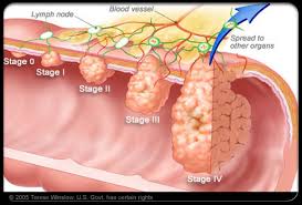 Bowel cancer is the third most common cancer affecting people in australia. Colon And Rectal Cancer Bayside Colorectal Group