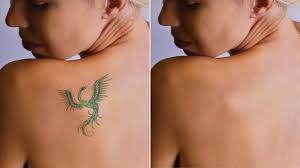 Enlever Un Tatouage Au Laser