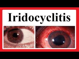 Image result for Ciliary Flush