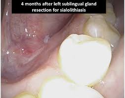 Image result for Sialolithiasis