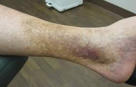 Most common cause of brown spots on lower legs. Pin On Prevent Varicose Veins