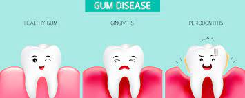 The Nature Of Gingivitis And How To Prevent It – Dentist Olds Alberta –  General & Family Dentistry