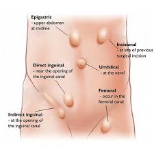 Image result for Inguinal hernia man