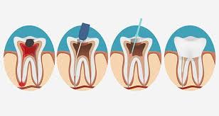 Over 100,000 spanish translations of english words and phrases. What Is A Root Canal Koplon Implant Family Dentistry