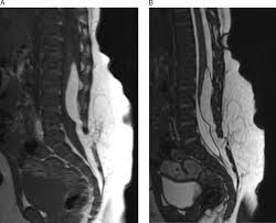 Image result for Spinal Dysraphism
