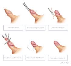 Image result for Phimosis