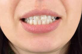The process uses essential oils to get rid of bacteria and toxins from the mouth. White Stuff On Teeth After Braces Teethwalls