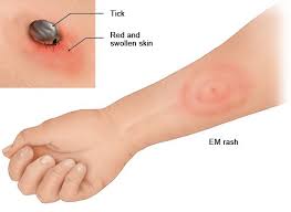 Image result for infected tick bite