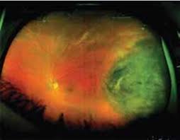 Image result for nevus sclerae