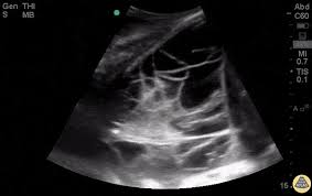 A loculated pleural effusion is not free flowing in. Pulmonary Tpa