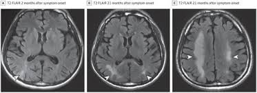 Serial Magnetic Resonance Imaging Changes In A Patient With Late Onset Cobalamin C Disease With A Misdiagnosis Of Metachromatic Leukodystrophy Jama Neurology X Mol
