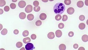 Of microcytosis and hypochromasia, peripheral blood smears of iron deficiency. Anemia Quiz Pathology Student