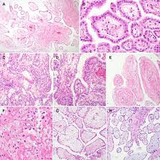 There are four main types of mesothelioma based on tumor location and cell type. Clinicopathological Characteristics Of Well Differentiated Papillary Mesothelioma Of The Peritoneum A Single Institutional Experience Of 12 Cases In Vivo