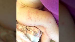 Outbreak Of Hand Foot And Mouth Disease Ctv News