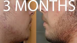 Minoxidil is considered a relatively safe drug. Minoxidil Beard 3 Months Incredible Results Timelapse Youtube