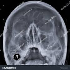 Image result for Sinus X Ray