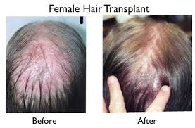 Teenage hair loss is usually caused by sickness and small bald patches on the scalp. Female Hair Loss Causes Diagnoses And Treatment New York