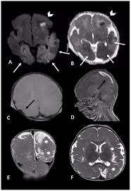 Brain Sciences Free Full Text Shaken Baby Syndrome Magnetic Resonance Imaging Features In Abusive Head Trauma Html