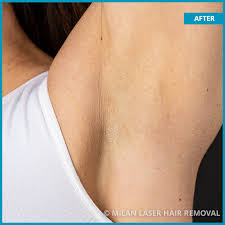When i arrived for my second session, engelman was excited to see how much progress i had. Underarm Before After Photos Of Laser Hair Removal Milan Laser In Tri Cities Tn