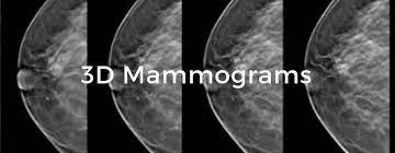 Dense breast tissue appears solid. 3d Mamograms Breast Tomosynthesis Breast Cancer School For Patients