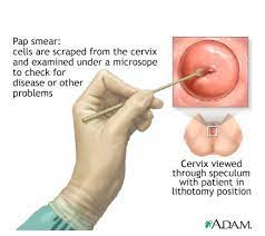The following tests may be used to diagnose cervical cancer: The End Of The Pap Test For Cervical Cancer Fox Chase Cancer Center Philadelphia Pa