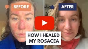 Image result for demodex rosacea