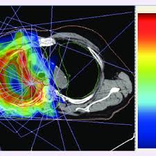 More than 90% of reported mesothelioma cases occur in the pleura. Pdf Intensity Modulated Radiotherapy For Relapsed Malignant Pleural Mesothelioma