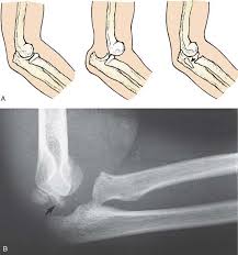 Image result for Radial Head Dislocation