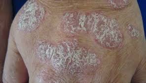 Image result for psoriasis