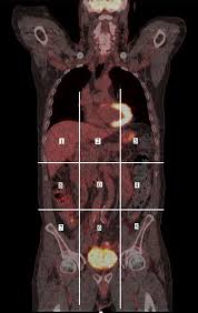 Your doctor may order imaging. Can 18f F Fdg Pet Ct Be Used To Assess The Pre Operative Extent Of Peritoneal Carcinomatosis In Patients With Colorectal Cancer Springerlink