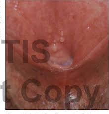 Figure 2 From Importance Of Dermoscopy To Diagnose Vulvar Vestibular  Papillomatosis Vs. Warts | Semantic Scholar