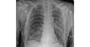 Image result for Flail Chest