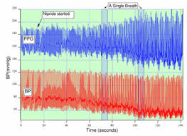 Photoplethysmogram Wikipedia