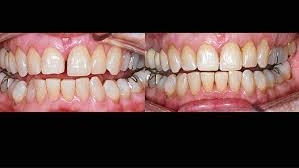 Lose zahnspange zur korrektur von kleinen zahnfehlstellungen. Zahnstellungskorrektur Mit Invisalign Auf Die Naturliche Schiene