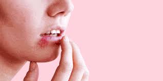 But there are ways to keep it in hibernation longer, and you can also take steps to. Are Cold Sores A Sign Of Herpes What Is Herpes And What Are The Symptoms