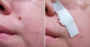 If you happen to have a pimple in one of these areas, you can cover it up with the fake beauty mark. Ways To Remove A Mole Beauty Waves
