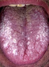 Image result for lichen planus on tongue)