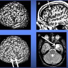 As is a mental disorder or disability. Pdf Neurofunctional Models Of Autistic Disorder And Asperger Syndrome Clues From Neuroimaging