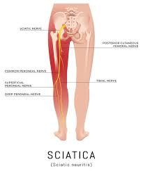 We did not find results for: Sciatica Lower Back Pain The Sciatic Nerve